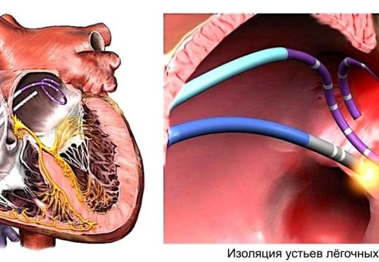 Обгаряне на сърцето, при аритмия