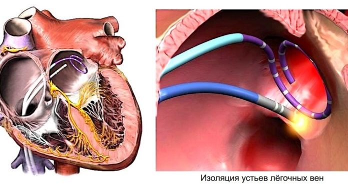 Обгаряне на сърцето, при аритмия