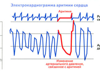Сърдечен ритъм при аритмия