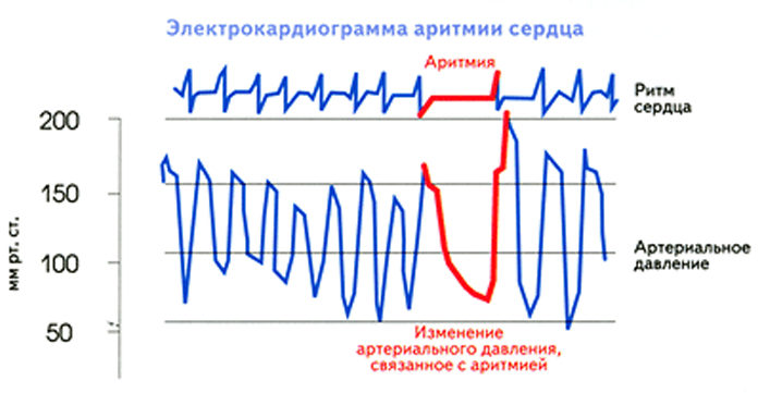 Сърдечен ритъм при аритмия