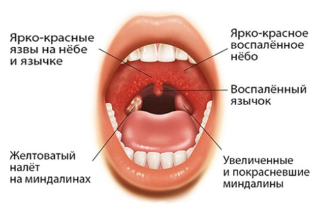 Болки в гърлото и тахикардия