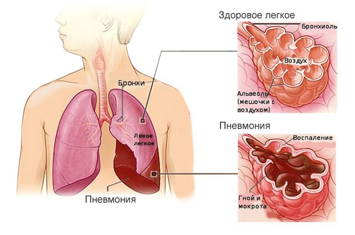 Налягане и пневмония