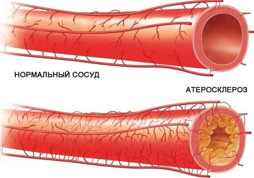 Органи на мишената при хипертония