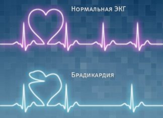 Синусоидальная брадикардия съдови заболявания
