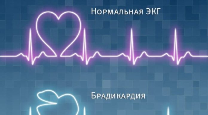 Синусоидальная брадикардия съдови заболявания