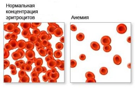 Тахикардия от анемия