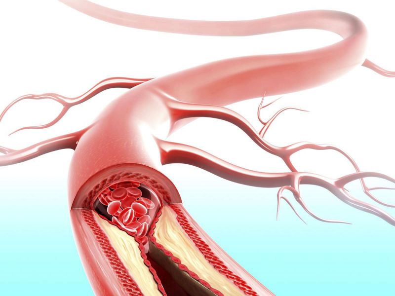 Систолическая артериална хипертония